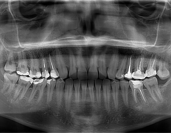 Dental X-Rays