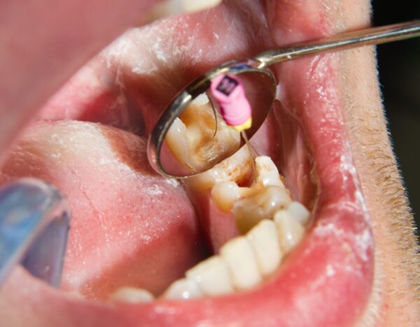 Root Canals
