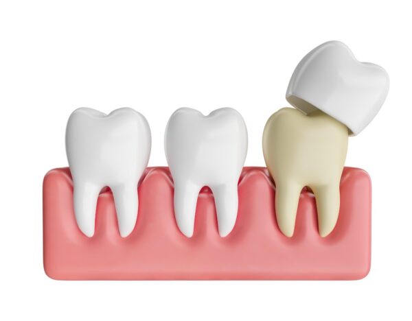 Dental Crown Process