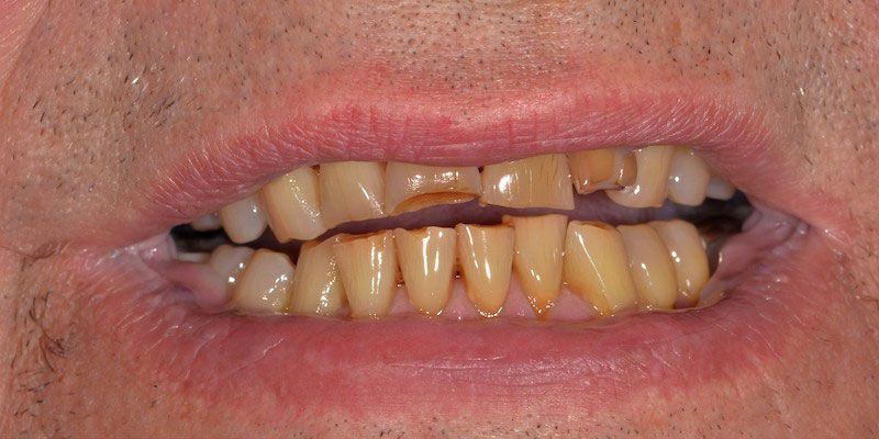 teeth-2-before teeth-2-before