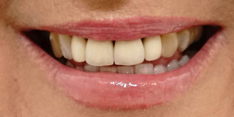 teeth-3-before teeth-3-before